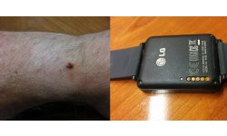 lg g watch corrosiongate